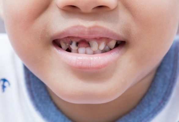sâu răng ở trẻ